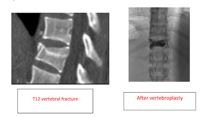 Vertebroplasty