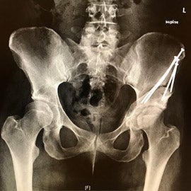 caption: An X-ray image of Kerrianne’s hip, post-surgery.