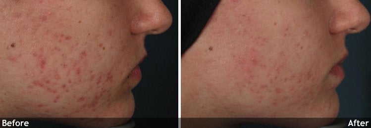 Acne and Other Scars