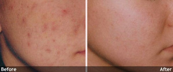 Acne and Other Scars