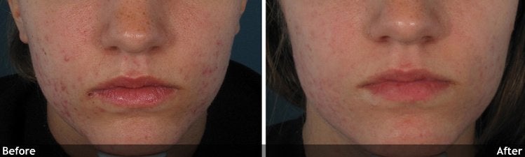 Acne and Other Scars