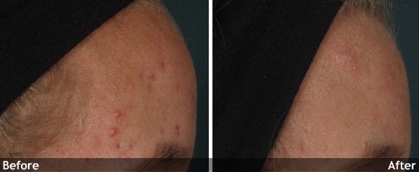 Acne and Other Scars