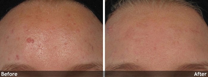Acne and Other Scars