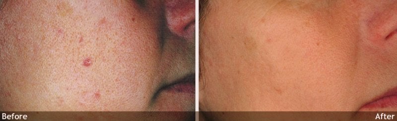 Acne and Other Scars