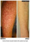 Laser Therapy for Vascular Lesions