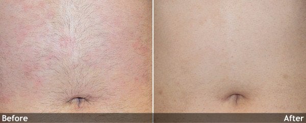Hair-Removal-Abdomen