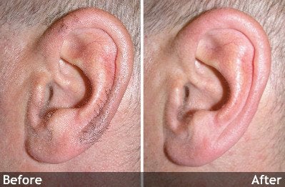 Hair-Removal-ear
