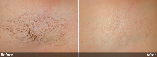 Hair-Removal-axilla