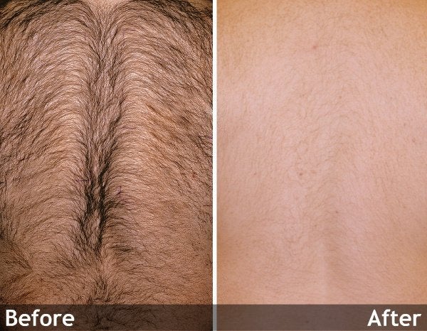 Hair-Removal-backs