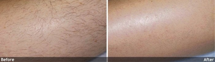Hair-Removal-calf
