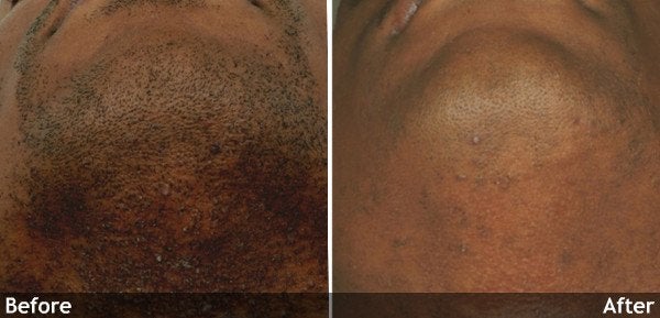 Hair-Removal-chin