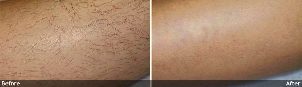 Hair-Removal-leg
