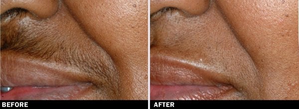 Hair-Removal-lip