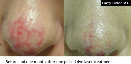 Laser Therapy for Vascular Lesions