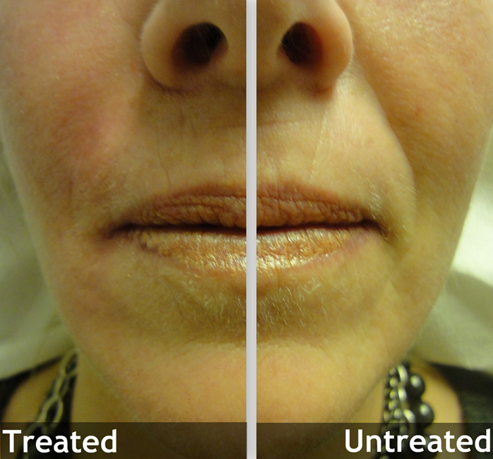 Skin Folds and Wrinkles Boston Medical Center