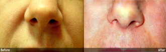 Restylane®