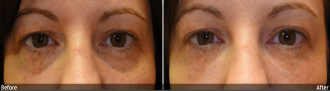 Restylane®