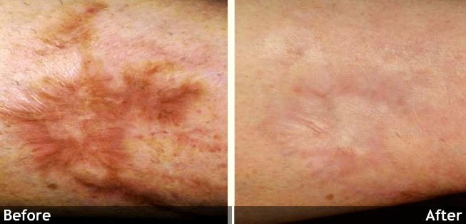 Acne and Other Scars