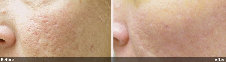 Acne and Other Scars
