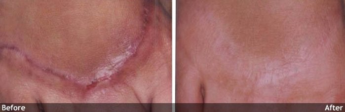 Acne and Other Scars