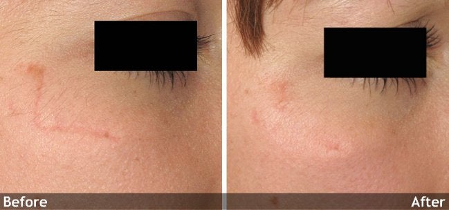 Acne and Other Scars