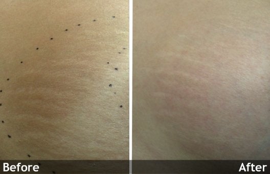Treatment for Stretch Marks