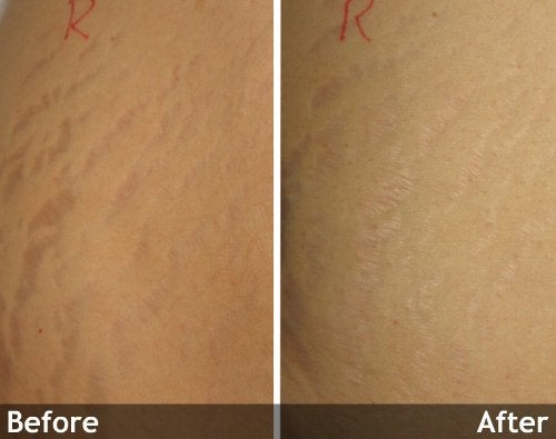 Treatment for Stretch Marks