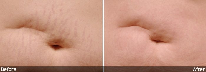 Treatment for Stretch Marks