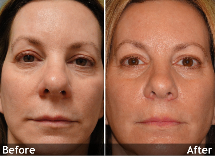 Laser Resurfacing