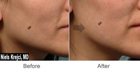 Botox