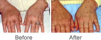 Laser Therapy for Brown Lesions or Brown Spots