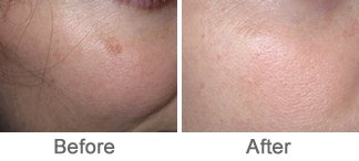 Laser Therapy for Brown Lesions or Brown Spots