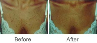 Laser Therapy for Brown Lesions or Brown Spots