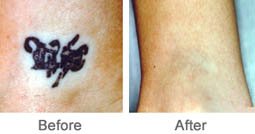 Laser for Tattoo Removal