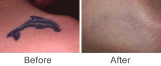Laser for Tattoo Removal