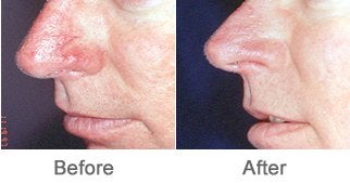 Laser Therapy for Vascular Lesions