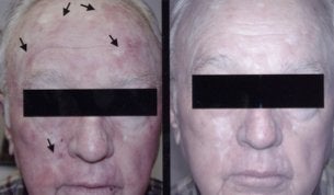 photodynamic therapy 1