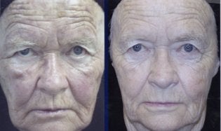 photodynamic therapy 2