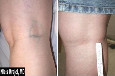 sclerotherapy large