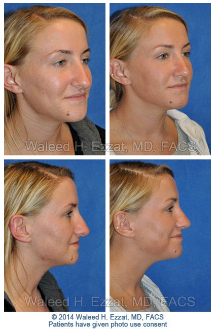 CIRURGIA NO NARIZ ! (OPERATE NOW) - nose surgery