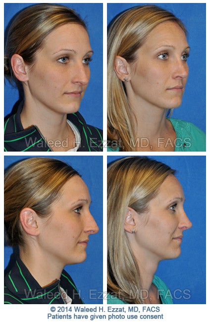 ezzat_female-rhinoplasty