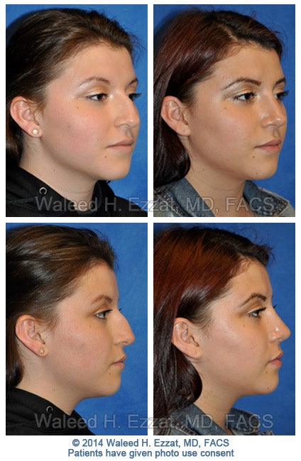 ezzat_female-rhinoplasty2