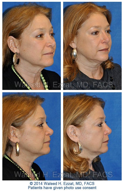 ezzat_female-revision-rhinoplasty