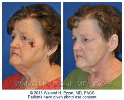 mohs-surgery2