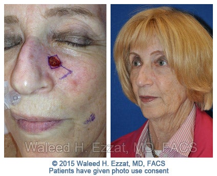 mohs-surgery4