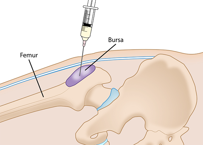 Relieve Hip Bursitis & Other Kinds Of Hip Pain