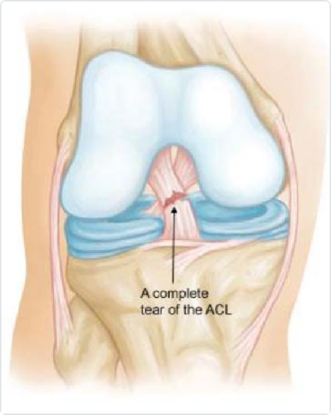 A complete tear ACL illustration