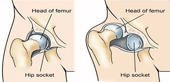 Developmental Dysplasia of the Hip (DDH)