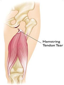 Hamstring Tear