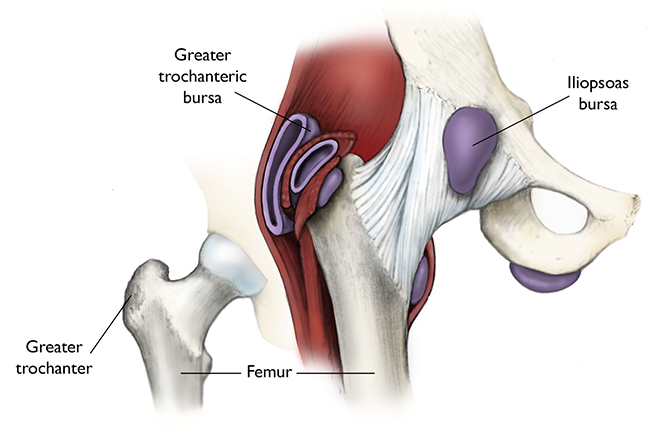 Hip Bursitis, Symptoms and Treatment Plans